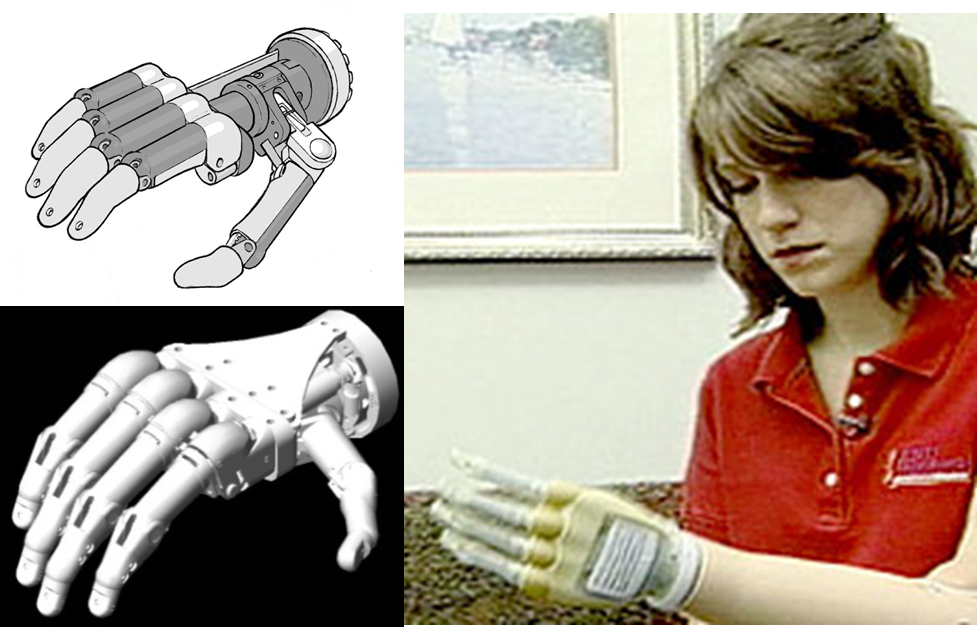 Read more about the article Prosthetic hand delivered to Touch Bionics